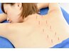 【筋肉の凝りへ徹底アプローチ】腰などの下半身のコリを解消！ルート鍼30分 