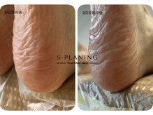 ロンディネ(Rondine)/韓国最新角質ケア・s-planing43