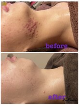 雅菜(miyabina)/思春期ニキビケア