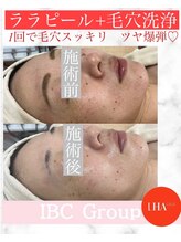 トータルサロンアイビーシー(トータルサロンIBC)/ツヤ爆弾！ララピール＋毛穴洗浄