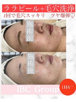 トータルサロンアイビーシー(トータルサロンIBC)/ツヤ爆弾!ララピール+毛穴洗浄