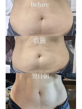 ファム 蓮台寺店(FAM)/レモンボトル 脂肪分解