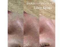リベルキョウト 京都駅前店(Liber Kyoto)/毛穴レス艶肌コース