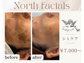 ノースフェイシャルズ(North facials)