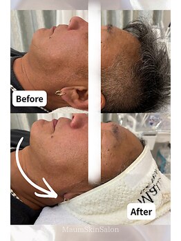 マウム(Maum)/男性も◎顎下すっきり・Vライン