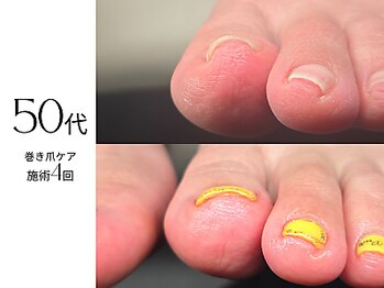 ジェルで巻き爪をケアできます♪