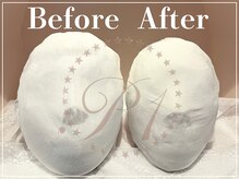 R-1ビューティーサロン 表参道/Before &After（6回）