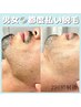 顔脱毛(ヒゲ脱毛OK)|¥5500