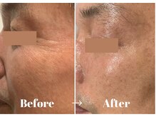 カラーリリー アンド ユン(Calla lily & yun)/ハーブピーリング+ヒト幹細胞