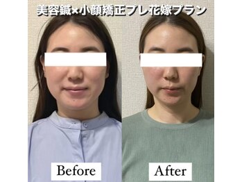 ハリカ 大阪梅田店(HARIKA)/SNSで話題のブライダル美容鍼