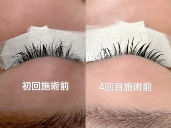 エース(ace)/4回目でこんなに変化が！