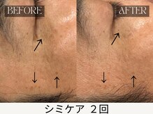 スキンジム(SKIN GYM)/シミケア2回効果 モニター3500円