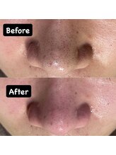 チル(Chill)/イチゴ鼻撃退ケア