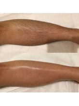 メディカル サンテロッソ(MEDICAL SANTEROSSO)/★メンズ脱毛★膝下ワックス+光