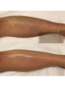 メディカル サンテロッソ(MEDICAL SANTEROSSO)/★メンズ脱毛★膝下ワックス+光