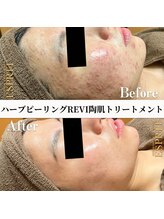 エスプリ 新宿店/ハーブピーリング新宿