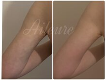 エルール トータルビューティ(Aileure total beauty)/DT術後ケア　二の腕