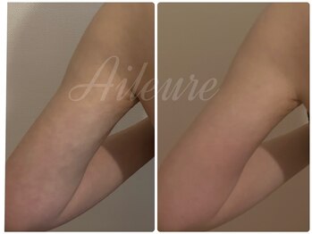 エルール トータルビューティ(Aileure total beauty)/DT術後ケア 二の腕