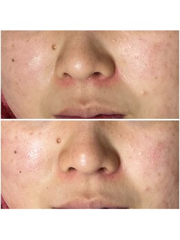 リンク(LiNK)/ハーブピーリング