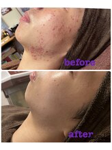 雅菜(miyabina)/メンズ！学生ニキビケア