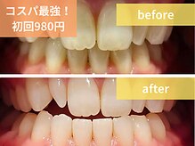当店のホワイトニングは痛みが少なく照射後の食事制限なし◎