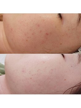 アンティクイーン(Antiqueen)/剥けるハーブピーリング 顔