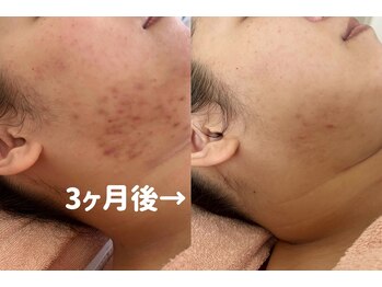 れふぇるん 足利店/30代 ニキビケア 施術6回
