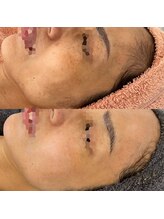 クラルテ(CLARTE)/ハーブリプロで肌質改善♪