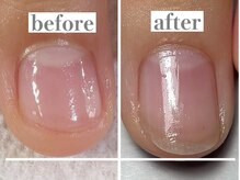 育成に特化したケアで深爪卒業↑左角もう少し♪ご相談はお気軽に