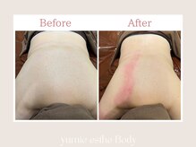 トータルビューティー ゆみえエステ(Total Beauty)/痩身/ハイパーナイフ/背中