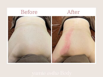 トータルビューティー ゆみえエステ(Total Beauty)/痩身/ハイパーナイフ/背中