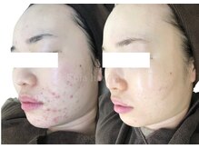 エピア 半田店(Epia)/繰り返すニキビ・敏感肌ケア