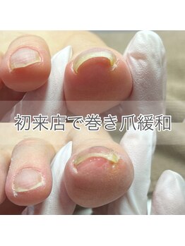 キュア(Cure.)/ご来店当日から巻き爪が緩和