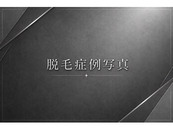 メンズラボ 京都山科店/【脱毛ビフォーアフター】