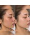 シノ 銀座(shino)の写真/    鏡を見るたび気になるほうれい線・たるみに徹底アプローチ