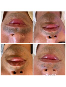 サロン ド ミモザ(Salon de Mimosa)/メンズ髭脱毛