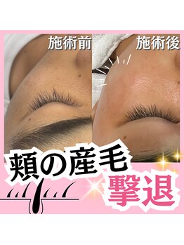 ホワイトワックス 名古屋金山店(WHITE WAX)/頬の産毛を撃退