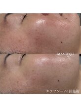 マニーク(MANIEQU)/エクソソーム