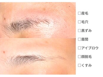 ピュアノア 垂水店/ 産毛脱毛 顔脱毛　神戸垂水明石