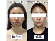 ハリカ 大阪梅田店(HARIKA)/ブライダル前にブライダル美容鍼