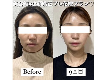 ハリカ 大阪梅田店(HARIKA)/ブライダル前にブライダル美容鍼