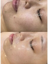 レシェルサロン(Lechelle Salon)/ダクトピーリング