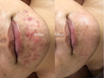 ヴィヴァンビー(Vivant+B)/before /after