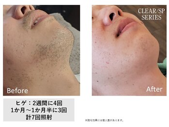 ザ エッセンシャル 碧南(THE Essential)/メンズ ヒゲ脱毛