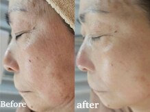 リセラージュ(Recellage)の雰囲気（【結果重視】グロッティプロ美肌フェイシャル★まずは血管ケア）