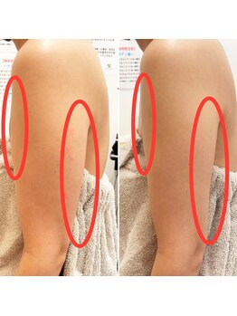 みつばちさろん/【ブラックスタンプ】二の腕