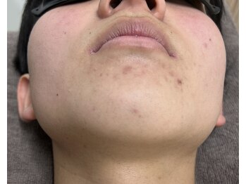 ナノハナ/ひげ脱毛