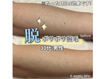サロン(SALON)/メンズ脱毛：腕