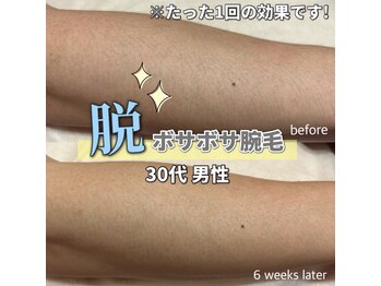 サロン(SALON)/メンズ脱毛：腕