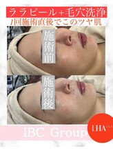 トータルサロンアイビーシー(トータルサロンIBC)/ツヤ爆弾！ララピール＋毛穴洗浄